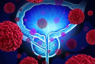 Risiko für neuerliches Karzinom nach Prostata-OP